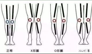 o型腿怎么办 o型腿怎么办
